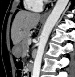 Median Arcuate Ligament Syndrome - CTisus CT Scan