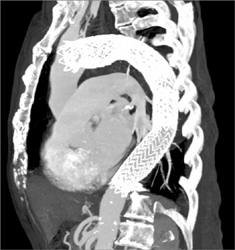 Stents in the Thoracic Aorta - CTisus CT Scan