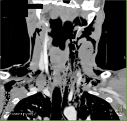 Pneumomediastinum - CTisus CT Scan