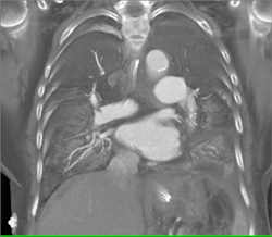 Left Lower Lung Consolidation - CTisus CT Scan