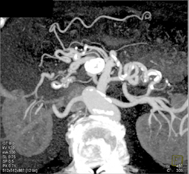 SMA Aneurysm and Collaterals Due to Median Arcuate Ligament Syndrome - CTisus CT Scan