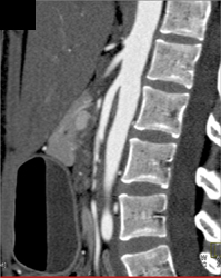 Superior Mesenteric Artery (SMA) Syndrome - CTisus CT Scan