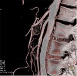 Superior Mesenteric Artery (SMA) Syndrome - CTisus CT Scan