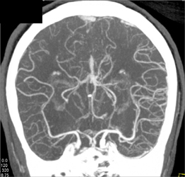 Cerebral Infarction With CTA - CTisus CT Scan