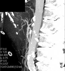 Median Arcuate Ligament Syndrome - CTisus CT Scan