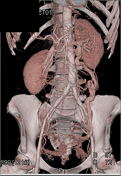 Median Arcuate Ligament Syndrome - CTisus CT Scan