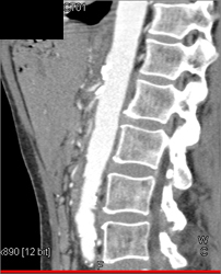 Median Arcuate Ligament Syndrome - CTisus CT Scan