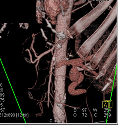 Median Arcuate Ligament Syndrome - CTisus CT Scan