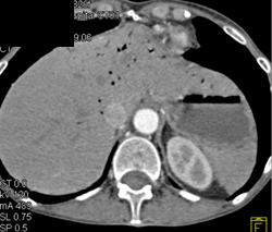 Ischemic Bowel With Pneumatosis - CTisus CT Scan