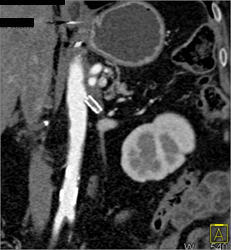 Occluded Renal Artery Stents - CTisus CT Scan