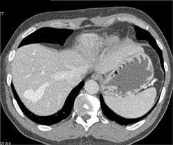 Av Fistulae - CTisus CT Scan