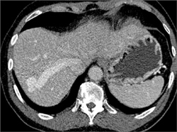 Av Fustulae - CTisus CT Scan