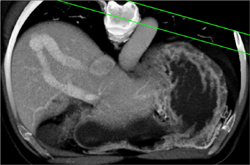 Av Fistulae - CTisus CT Scan