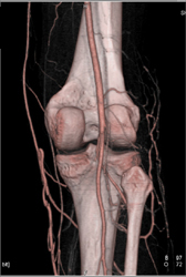 Patent Popliteal Artery With Bone Removal - CTisus CT Scan