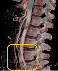 VRT Vs MIP of IMA - CTisus CT Scan