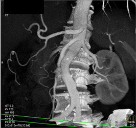 Normal Celiac Axis - CTisus CT Scan