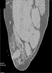 Bleed in Thigh on CTA Status Post Gunshot Wound - CTisus CT Scan