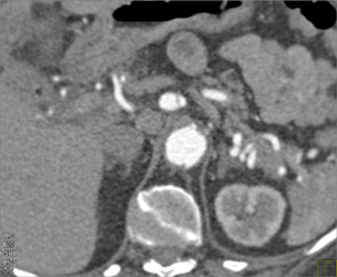 Focal SMA Dissection - CTisus CT Scan