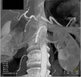 Hepatic Artery Arises Directly Off Aorta - CTisus CT Scan