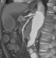 Stenosis Off SMA and Celiac and Abdominal Aortic Aneurysm (AAA) - CTisus CT Scan