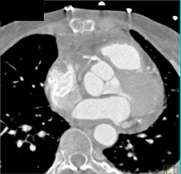 Repair of Ascending Aorta - CTisus CT Scan