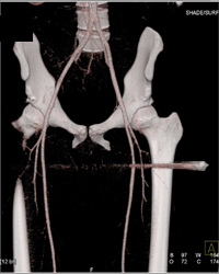 GSW Thigh Without Injury to Vessels - CTisus CT Scan