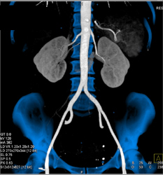 Example of Bone Removal With Automated Software - CTisus CT Scan