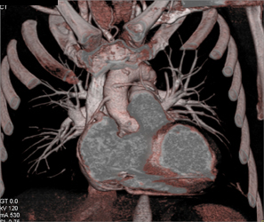 Bypass Grafts - CTisus CT Scan