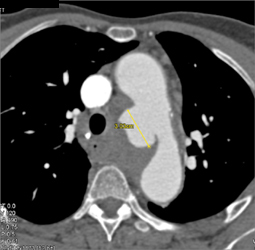 Ulceration of Aorta With Bleed Into Mediastinum and Invasion of Left Mainstem Bronchus - CTisus CT Scan