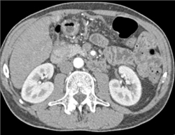 Vasculitis With SMA Aneurysm - CTisus CT Scan