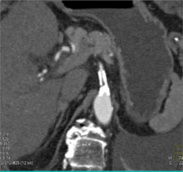 Stent With Early Stenosis - CTisus CT Scan