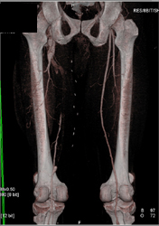 Occluded Right Superficial Femoral Artery (SFA) - CTisus CT Scan