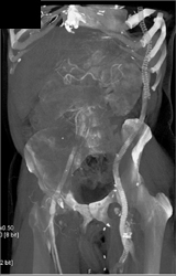 Axillary Fem-bypass Graft??? - CTisus CT Scan