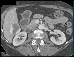 Renal Vein Thrombus - CTisus CT Scan