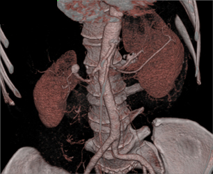 Renal Artery Aneurysm - CTisus CT Scan