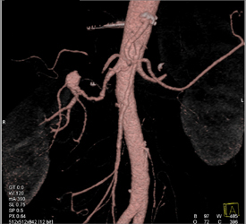 Renal Artery Aneurysm - CTisus CT Scan