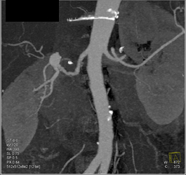 Renal Artery Aneurysm - CTisus CT Scan