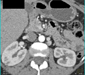 Renal Artery Aneurysm - CTisus CT Scan