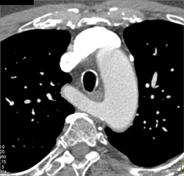 Aberrant Right Subclavian Artery - CTisus CT Scan