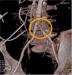 Iliac Artery Stenosis on Left - CTisus CT Scan