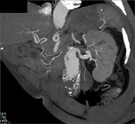 Abdominal Aortic Aneurysm (AAA) - CTisus CT Scan