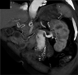 Infrarenal Abdominal Aortic Aneurysm (AAA) With Different Rendering Techniques and Edits - CTisus CT Scan