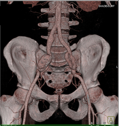 Focal Iliac Artery Aneurysm - CTisus CT Scan