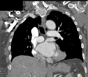 Pulmonary Arteriovenous Malformation (PAVM) With Different Renderings and Edits - CTisus CT Scan