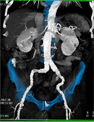 Endovascular Stent With Stenosis Evaluation - CTisus CT Scan