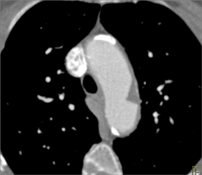 Focal Plaque in the Aortic Arch - CTisus CT Scan