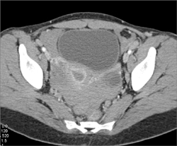 Pelvic Blood Due to Bleed From An Aneurysm - CTisus CT Scan