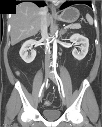 IVC Filter With Distal Clot - CTisus CT Scan