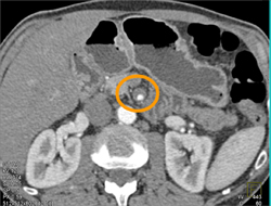 SMA Vasculitis - Vascular Case Studies - CTisus CT Scanning
