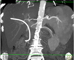 Hepatic Artery Stenosis S/P Transplant - CTisus CT Scan